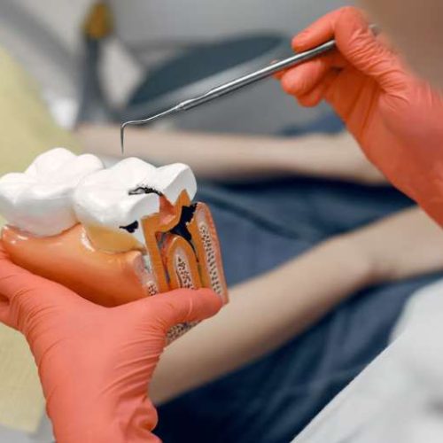 Root Canal Treatment Cost in Kolkata: Everything You Need to Know